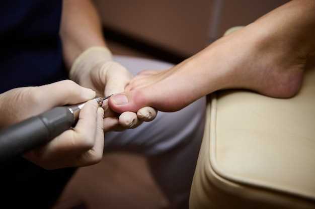Что такое онихолизис и как он влияет на ногти